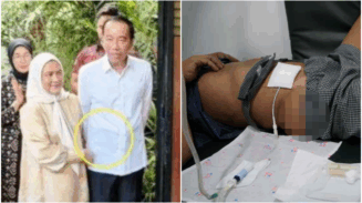 Apa Itu CAPD? Jokowi Disebut Pakai Alat Kesehatan Khusus di Perut saat Ultah ke-64