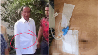 Tak Hanya Wajah, Perut Jokowi Juga Disorot Saat Acara Ulang Tahun, Dokter Tifa Duga Itu Alat CAPD