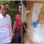 Tak Hanya Wajah, Perut Jokowi Juga Disorot Saat Acara Ulang Tahun, Dokter Tifa Duga Itu Alat CAPD