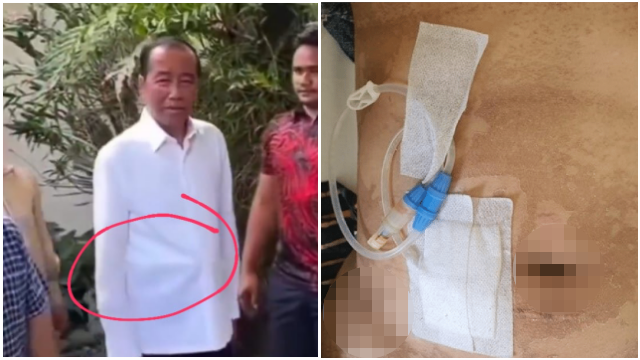 Tak Hanya Wajah, Perut Jokowi Juga Disorot Saat Acara Ulang Tahun, Dokter Tifa Duga Itu Alat CAPD